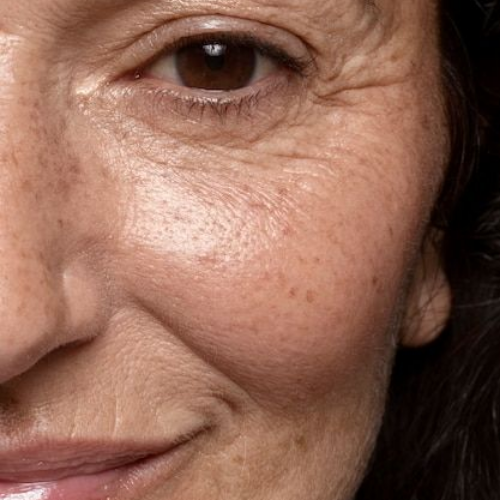 Ageing Skin